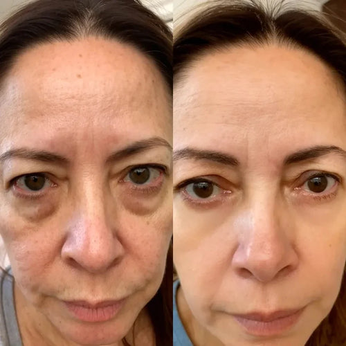 RevitalEyes® 2 en 1: terapia de luz roja + EMS para eliminar las bolsas de los ojos.