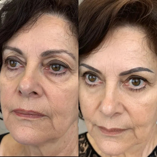 RevitalEyes® 2 en 1: terapia de luz roja + EMS para eliminar las bolsas de los ojos.