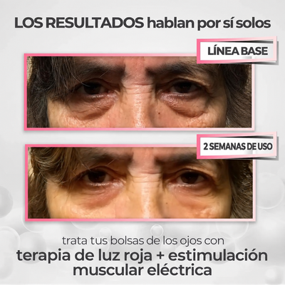 RevitalEyes® 2 en 1: terapia de luz roja + EMS para eliminar las bolsas de los ojos.