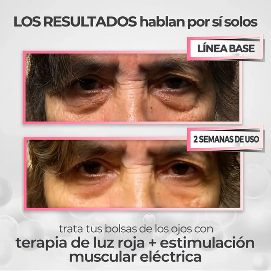 RevitalEyes® 2 en 1: terapia de luz roja + EMS para eliminar las bolsas de los ojos.